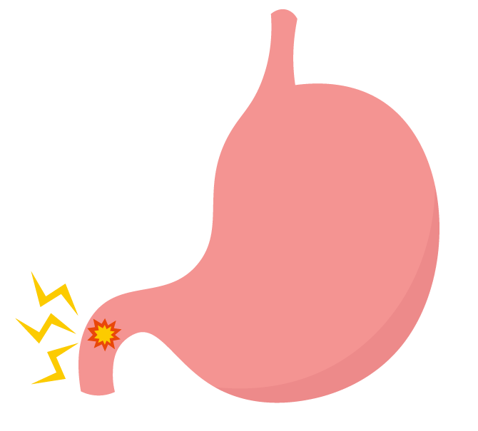 十二指腸潰瘍とはどんな病気？