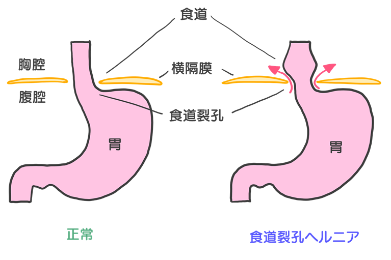 食道裂孔ヘルニアとはどんな病気？