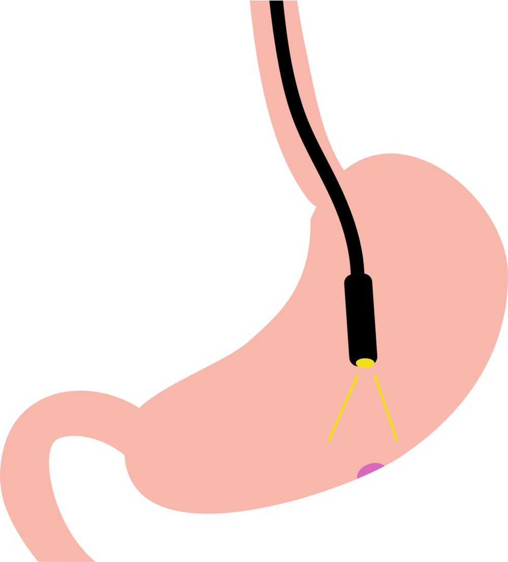 胃がんの早期発見に！胃カメラ検査（胃内視鏡）ができること