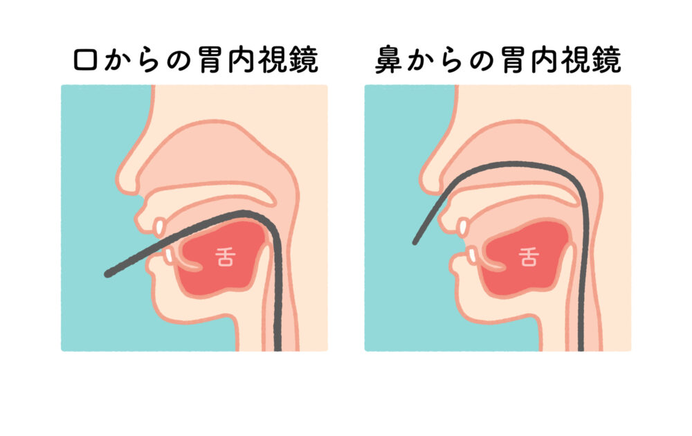 鼻からの「経鼻内視鏡」が選択可能