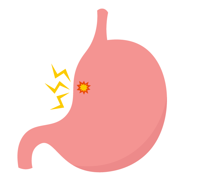 胃潰瘍とはどんな病気？