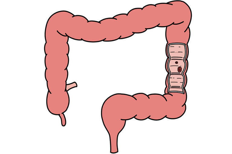 大腸がんとはどんな病気？