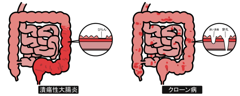 潰瘍性大腸炎とクローン病の違い