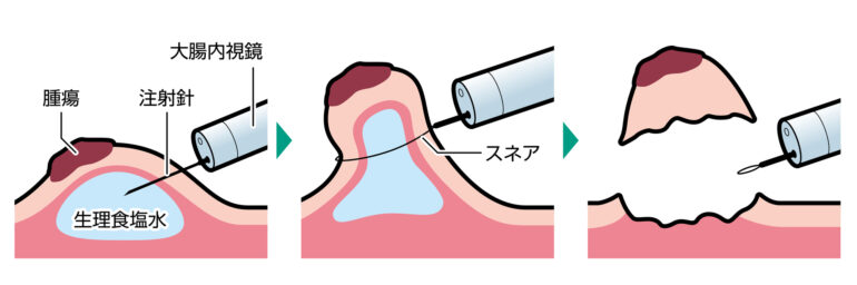 EMR（内視鏡的粘膜切除術）