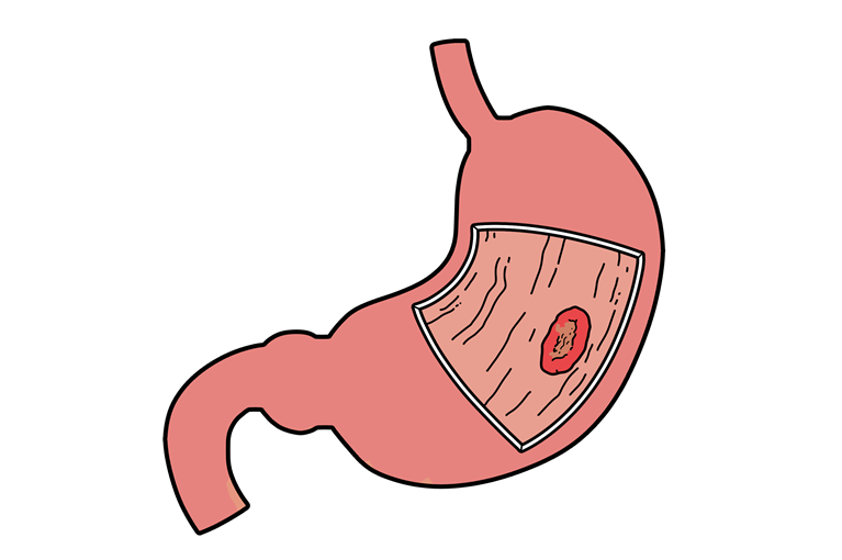 胃がんとは